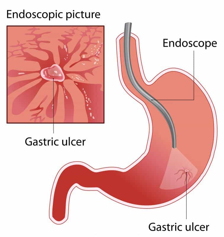 What is a Gastric Ulcer? (with pictures)