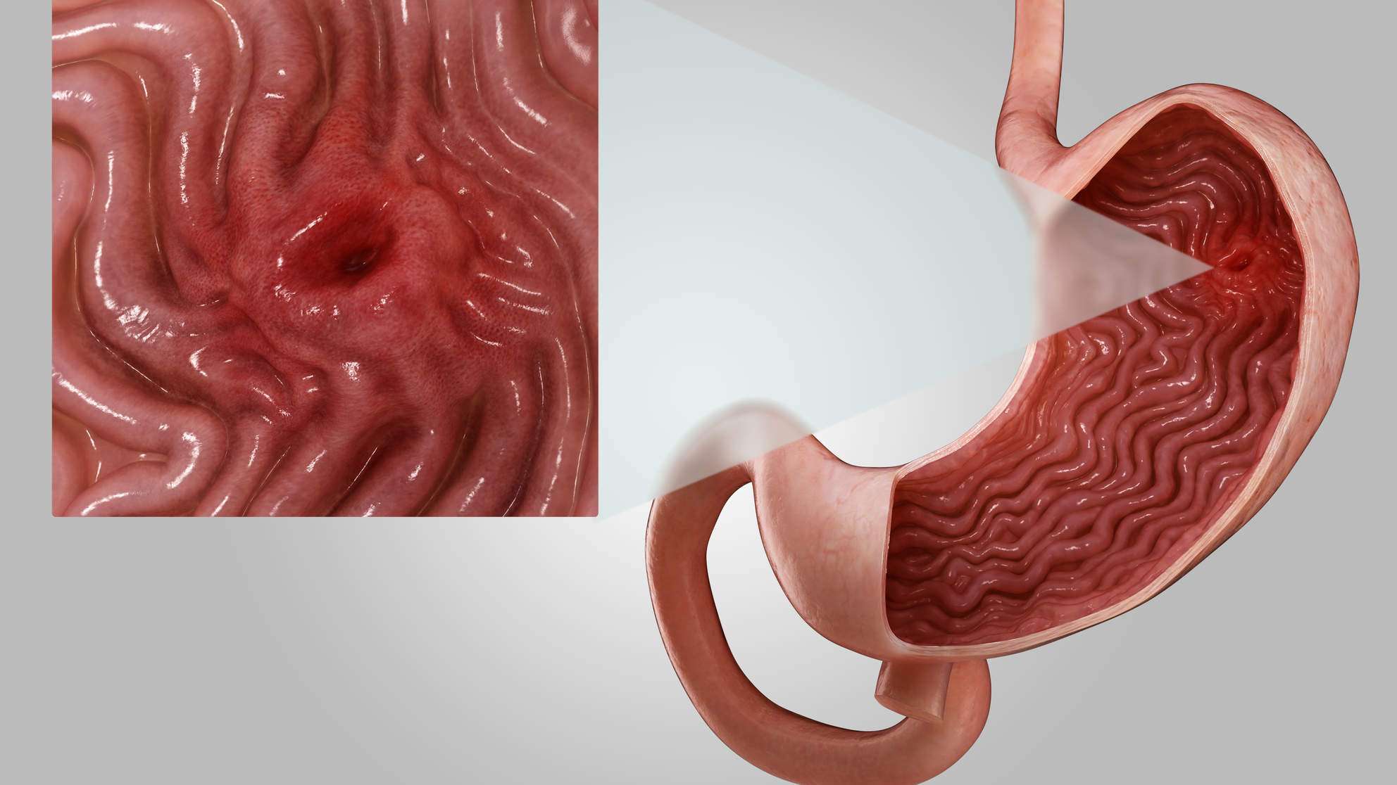 What Is a Stomach Ulcer? Gastroenterologists Explain Peptic Ulcers ...