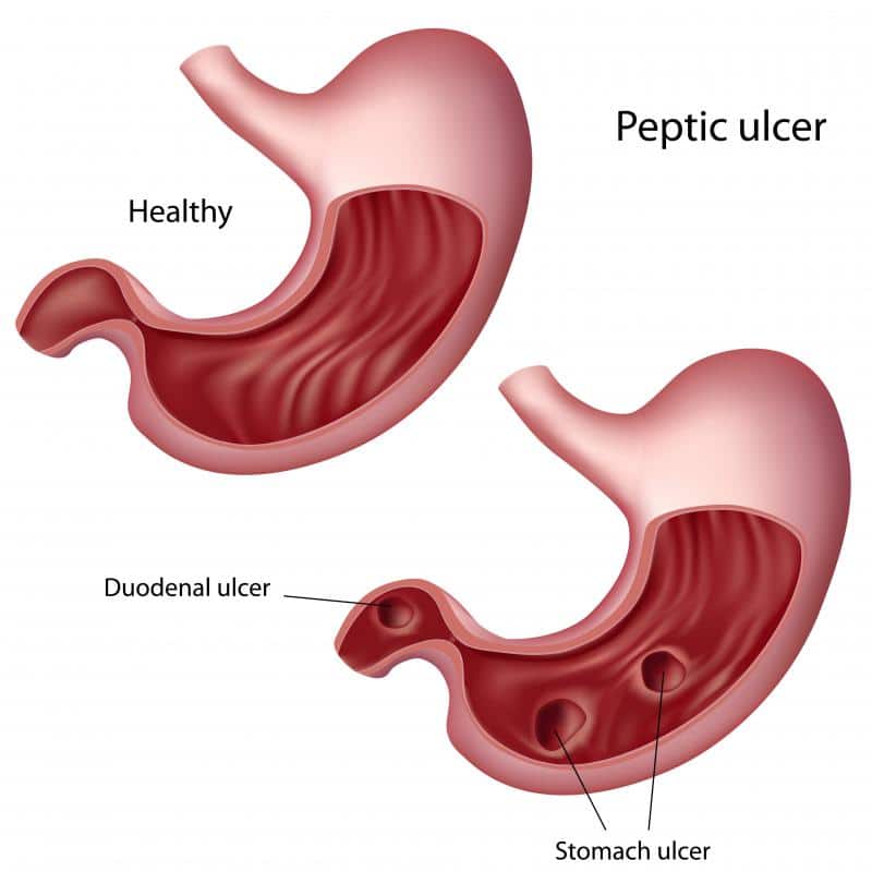 What is the Difference Between Gastritis and an Ulcer?