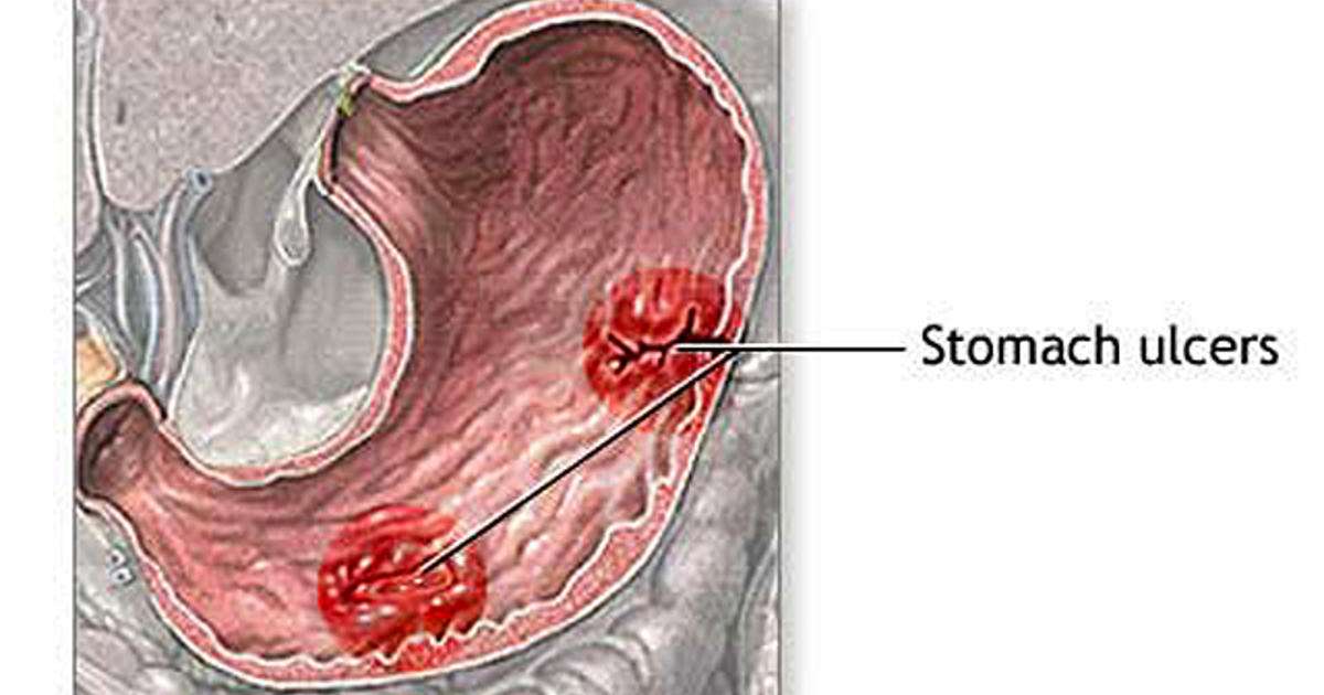 What Is Ulcer In Stomach