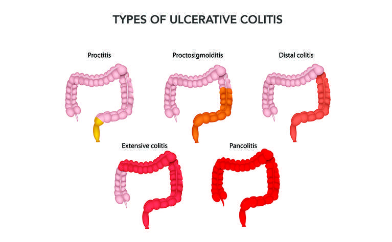 What is ulcerative colitis (UC)