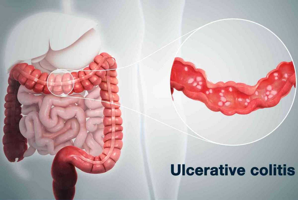 What is Ulcerative Colitis? What are its Symptoms, Causes, and Treatment?