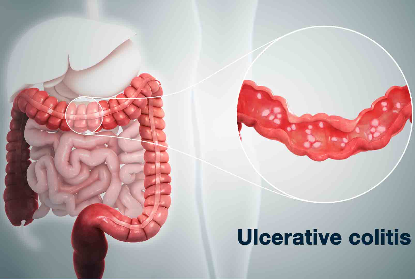 What is Ulcerative Colitis? What are its Symptoms, Causes ...