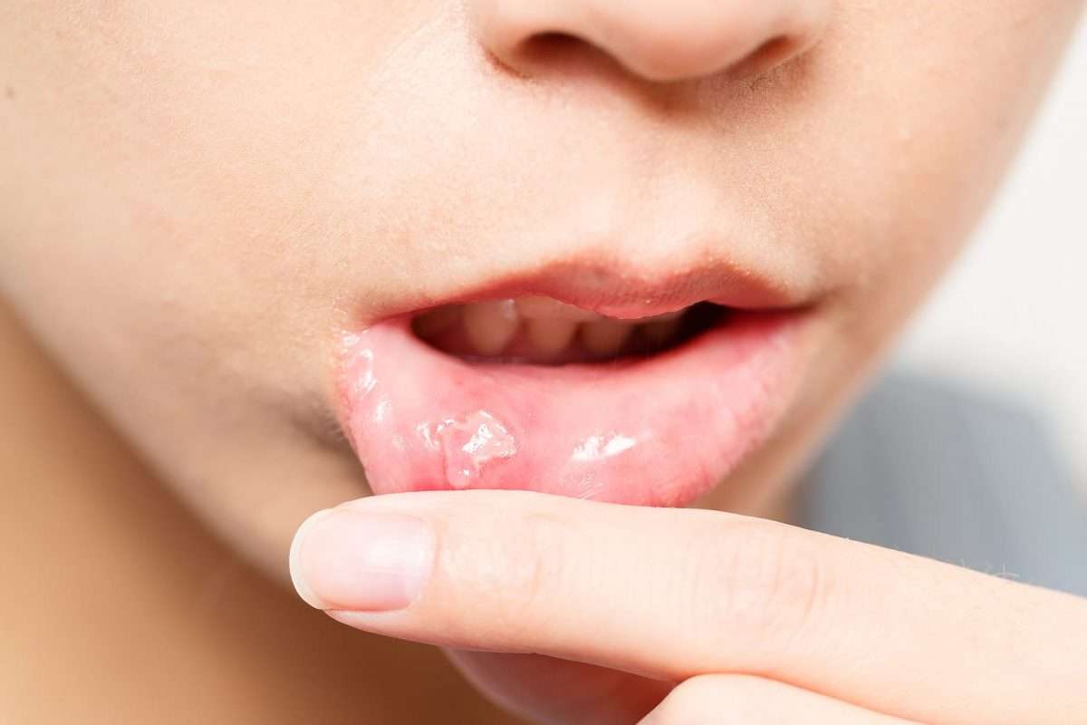 What to Do About That Mouth Ulcer