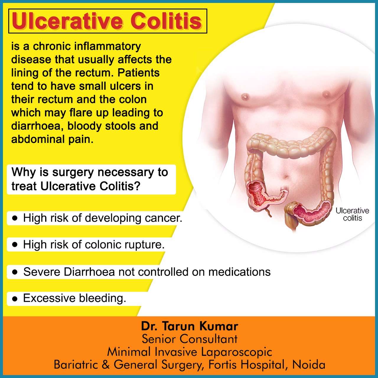 What To Do For Ulcerative Colitis Flare Up