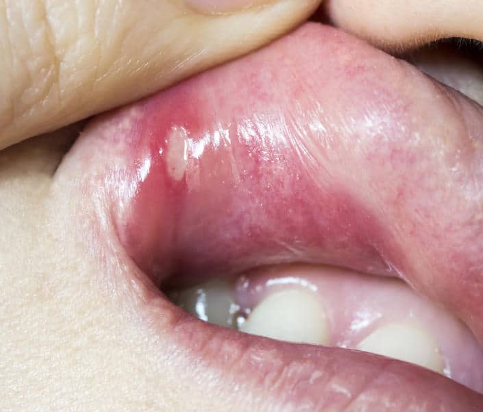 What to know about canker sores, the bumps that form on your mouth or ...