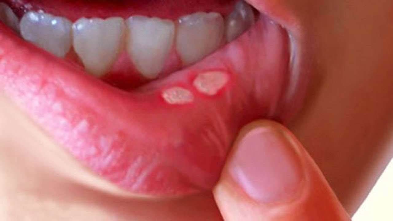 WHY MOUTH ULCER OCCUR CAUSES, SYMPTOMS AND TREATMENTÙÙÛ? ...